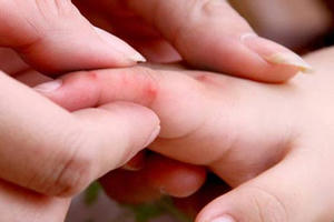 Dịch chân tay miệng có dấu hiệu gia tăng