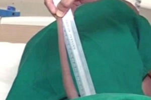 Nam thanh niên "sót" chiếc đuôi dài gần 18cm