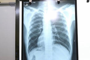 Nam thanh niên có tim bên phải