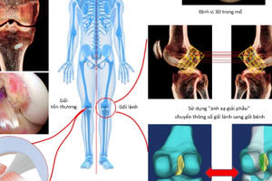 Vinmec tái tạo chính xác dây chằng chéo trước khớp gối với phương pháp “ánh xạ giải phẫu” độc quyền