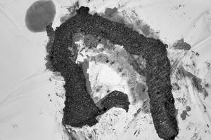 Hàng trăm khối u chi chít trong ruột già bệnh nhân