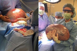 Mang khối u to như bụng bầu 9 tháng