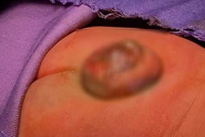 Bé 2 ngày tuổi bị thoát vị màng não tủy