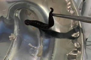 Gắp con đỉa dài 10cm ra khỏi mũi một bé gái 14 tuổi