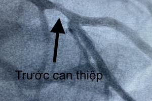 Ngưng tim 90 phút, một bác sĩ ở Cần Thơ được cứu sống thần kì