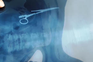 Hoảng hồn phát hiện kéo bị “bỏ quên” trong bụng sau gần 20 năm phẫu thuật