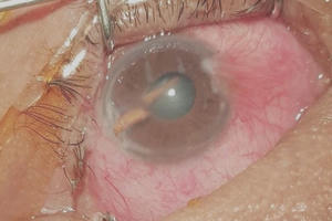 Chấn thương nặng vì dụi mắt sau khi bị gai mây đâm xuyên nhãn cầu