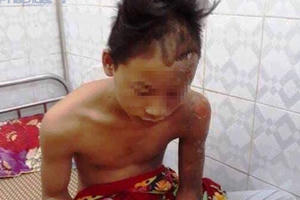 Bị sét đánh trúng đầu, nam sinh thoát chết trong gang tấc