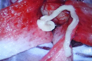 Bệnh nhân bị ký sinh trùng 7cm chui vào não