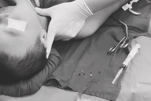 Bé 11 tháng tuổi tử vong vì bị hóc thạch