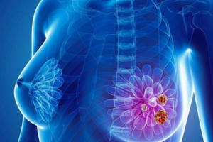 Cảnh báo độ tuổi mắc ung thư vú ngày càng trẻ hóa