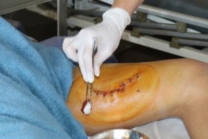 Quảng Ninh: Nam thanh niên nhập viện do mở bình rượu ngâm phát nổ