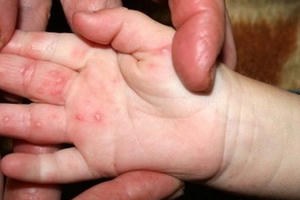 Trẻ vẫn có thể nhiễm bệnh tay chân miệng nhiều lần