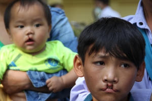 Phẫu thuật miễn phí cho trẻ em bị hở môi, hàm ếch tại khu vực phía Bắc