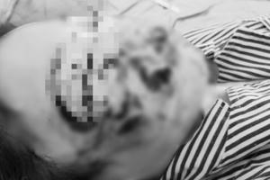 Tuyên Quang: Bé gái 10 tuổi bị chó cắn khiến mặt bị biến dạng