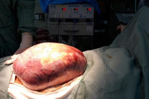 Mổ tách khối u "khủng" nặng 5kg, cứu sống cô gái trẻ ở Quảng Bình