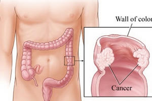 Những dấu hiệu nhận biết ung thư đại trực tràng