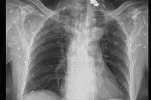 Rùng mình trước hình X - quang của người mê... ăn sống