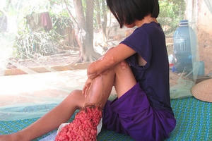 Giật mình với căn bệnh quái lạ của cô gái mới 25 tuổi