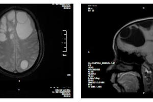 Ổ sán khổng lồ 'lúc nhúc' trong não người đàn ông ở Phú Thọ