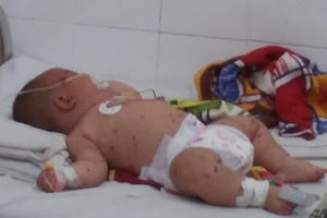 Viêm não mô cầu nguy hiểm như thế nào?