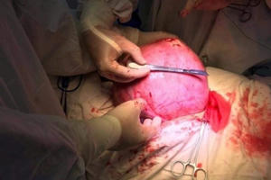 Hy hữu: Cắt bỏ u xơ tử cung "khổng lồ", to bằng thai nhi 9 tháng