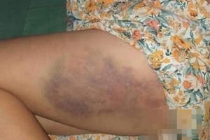 Đắk Lắk: Phạt tiền, tạm đình chỉ giảng dạy 3 tháng với giáo viên đánh bầm đùi học sinh