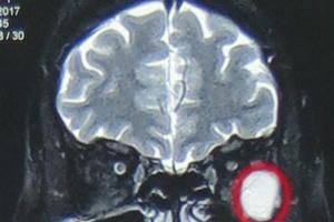 Mắt sưng đau, chảy nước mắt coi chừng U hốc mắt