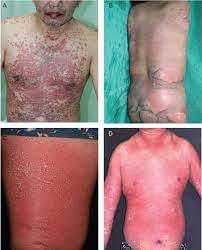 Phản ứng có hại trên da nghiêm trọng khi sử dụng thuốc atezolizumab