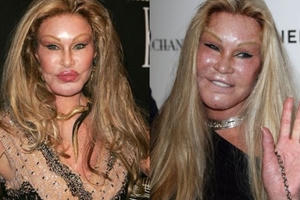 Những ca phẫu thuật thẩm mỹ kinh hoàng nhất trong lịch sử