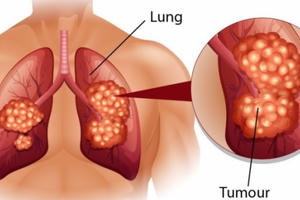 Dấu hiệu điển hình của bệnh ung thư phổi