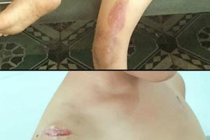 Phẫn nộ với hình ảnh bé trai 6 tuổi bị cha dượng bạo hành, châm thuốc lá đang cháy vào người