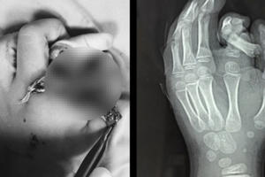 Ngón trỏ của bé trai bị đứt rời, dập nát vì cho tay vào máy giặt