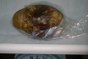 "Choáng" với viên sỏi nặng 1,5 kg được gắp ra từ người bệnh nhân