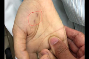 Bị chó ốm cắn vào tay, nữ bác sĩ thú y trẻ tuổi tử vong vì bệnh dại