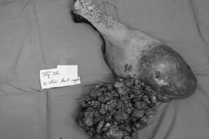 Cô gái 29 tuổi “đeo” khối u khủng hàng chục năm