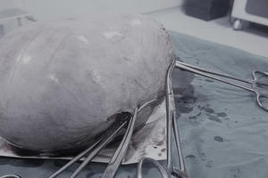 Nghệ An: Cắt bỏ khối u 1,8 kg cho nữ bệnh nhân 40 tuổi