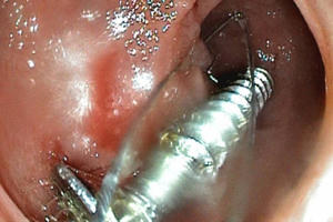 Kinh hoàng hình ảnh ốc vít sắc nhọn dài đến 3,5 cm trong cơ thể bé 20 tháng tuổi