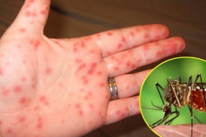 Cách phân biệt sốt xuất huyết với sốt virus thông thường