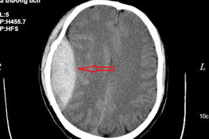 Phẫu thuật cứu sống bệnh nhân ngã từ độ cao 3m
