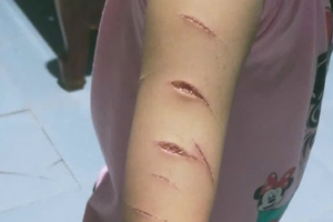 Chủ tịch UBND tỉnh Cà Mau lên tiếng vụ bé gái lớp 5 bị chị họ gây thương tích