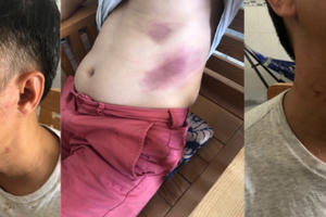 Người đàn ông dính đa chấn thương sau khi bị tạm giữ ở Phú Quốc