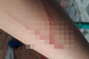 Thông tin bất ngờ vụ việc nghi vấn bé gái bị hiếp dâm với vết thương bí ẩn ở tay