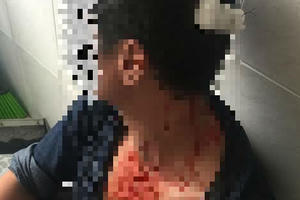 Vụ bất ngờ bị đối tượng từng có tiền án cùng nhóm người hành hung: Nạn nhân bị chấn thương sọ não