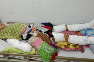 Ông bố đơn thân bị hoại tử tay chân do não mô cầu