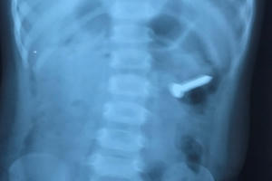 Nội soi phát hiện đinh xoắn ốc dài 3cm trong dạ dày bé gái 2 tuổi