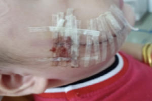 Xót xa trước hình ảnh cháu bé 2 tuổi bị chó cắn tổn thương mặt Xót xa trước hình ảnh cháu bé 2 tuổi bị chó cắn tổn thương mặt