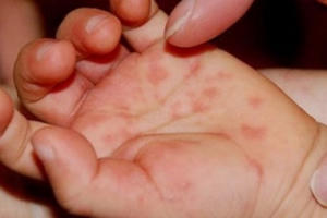 Những dấu hiệu “tố cáo” con bạn mắc tay chân miệng