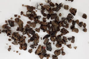 Sỏi thận "khổng lồ" hiếm gặp trong thận nam bệnh nhân