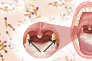 Cục Y tế dự phòng khuyến cáo người dân cần thực hiện 5 bước phòng tránh bệnh Bạch hầu Cục Y tế dự phòng khuyến cáo người dân cần thực hiện 5 bước phòng tránh bệnh Bạch hầu